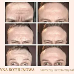 Jak działa botoks? Mechanizm, efekty i bezpieczny zabieg