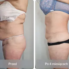 Liposukcja: Co to jest? Pełny przewodnik po zabiegu.