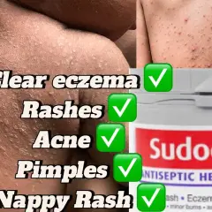 Sudocrem na pryszcze: Czy krem dla dzieci ratuje cerę trądzikową?