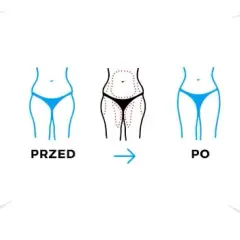Liposukcja: Czy jest bezpieczna? Dowiedz się, zanim podejmiesz decyzję