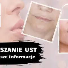 Powiększanie ust: Bezpieczeństwo, efekty, koszty wszystko, co musisz wiedzieć