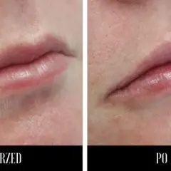 Kwas hialuronowy do ust: Jak wybrać idealny dla naturalnego wyglądu?