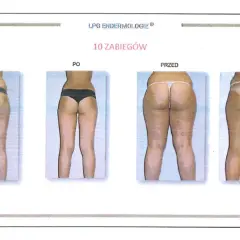 Endermologia: Czy warto inwestować? Efekty, koszty, wady