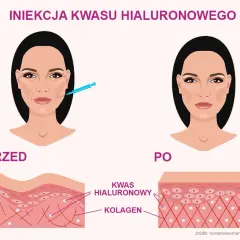 Co daje kwas hialuronowy? Odkryj pełnię korzyści dla skóry!