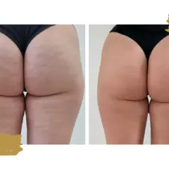Endermologia: na czym polega? Przewodnik po zabiegu i efekty!
