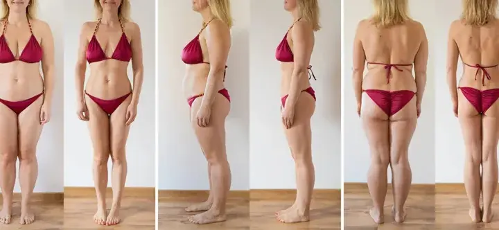 Liposukcja: Jak wygląda zabieg? Pełny przewodnik i rekonwalescencja
