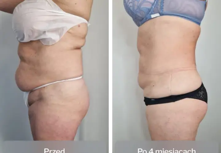 Liposukcja: Co to jest? Pełny przewodnik po zabiegu.