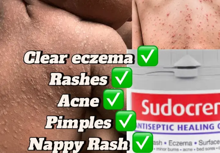 Sudocrem na pryszcze: Czy krem dla dzieci ratuje cerę trądzikową?