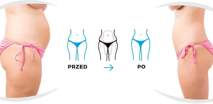 Liposukcja: Czy jest bezpieczna? Dowiedz się, zanim podejmiesz decyzję