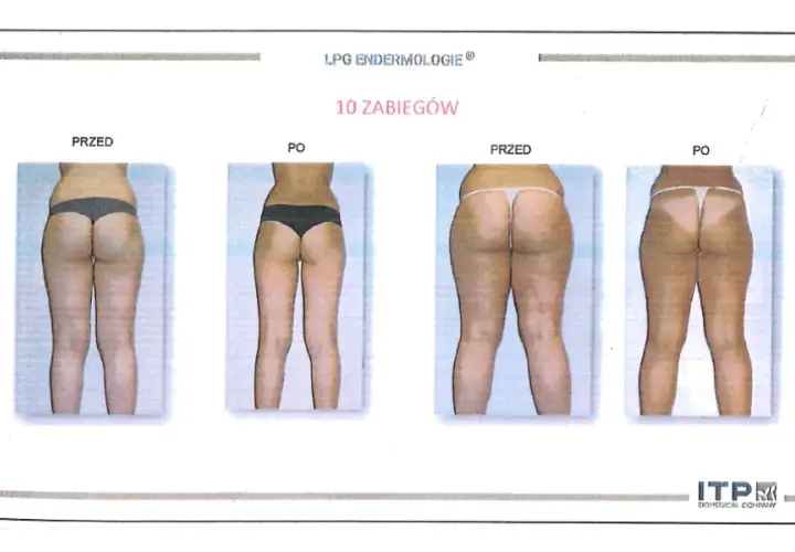 Endermologia: Czy warto inwestować? Efekty, koszty, wady
