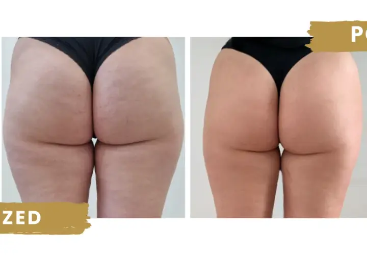 Endermologia: na czym polega? Przewodnik po zabiegu i efekty!