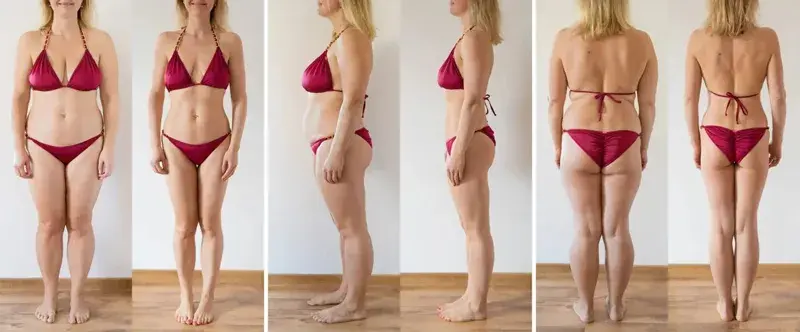 Liposukcja: Jak wygląda zabieg? Pełny przewodnik i rekonwalescencja