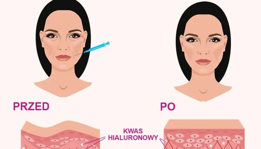 Co daje kwas hialuronowy? Odkryj pełnię korzyści dla skóry!