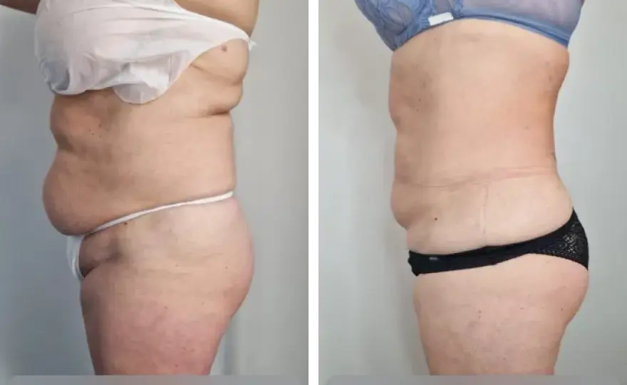 Liposukcja: Co to jest? Pełny przewodnik po zabiegu.