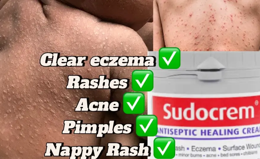 Sudocrem na pryszcze: Czy krem dla dzieci ratuje cerę trądzikową?