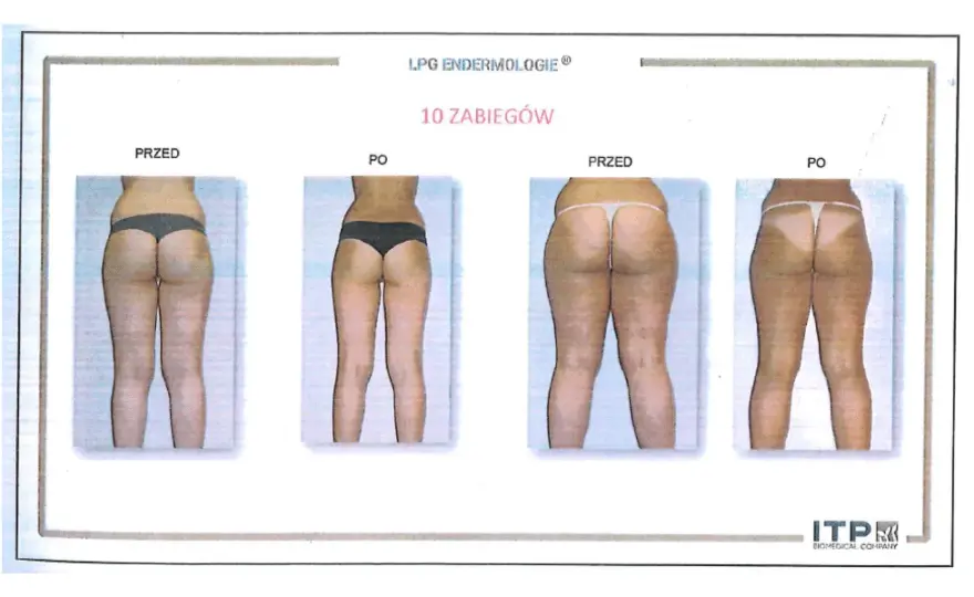 Endermologia: Czy warto inwestować? Efekty, koszty, wady