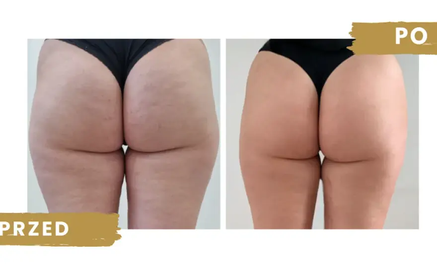 Endermologia: na czym polega? Przewodnik po zabiegu i efekty!