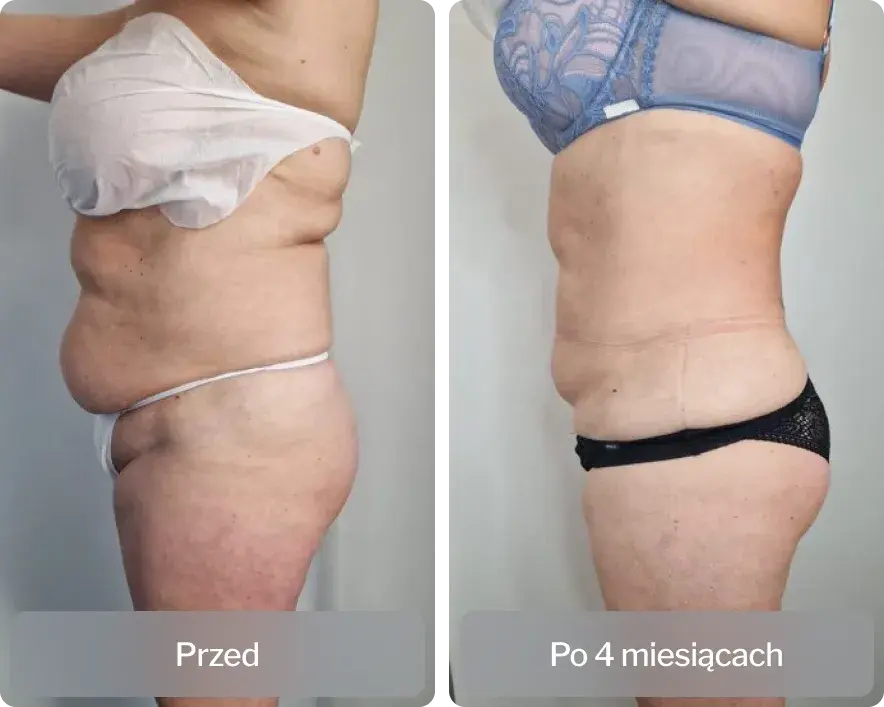 Liposukcja: Co to jest? Pełny przewodnik po zabiegu.