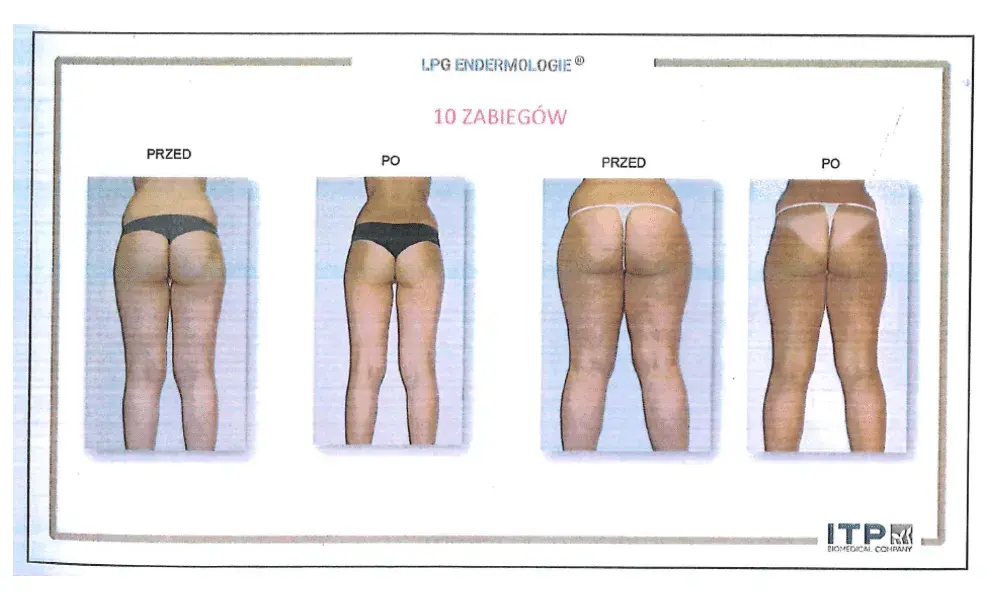 Endermologia: Czy warto inwestować? Efekty, koszty, wady