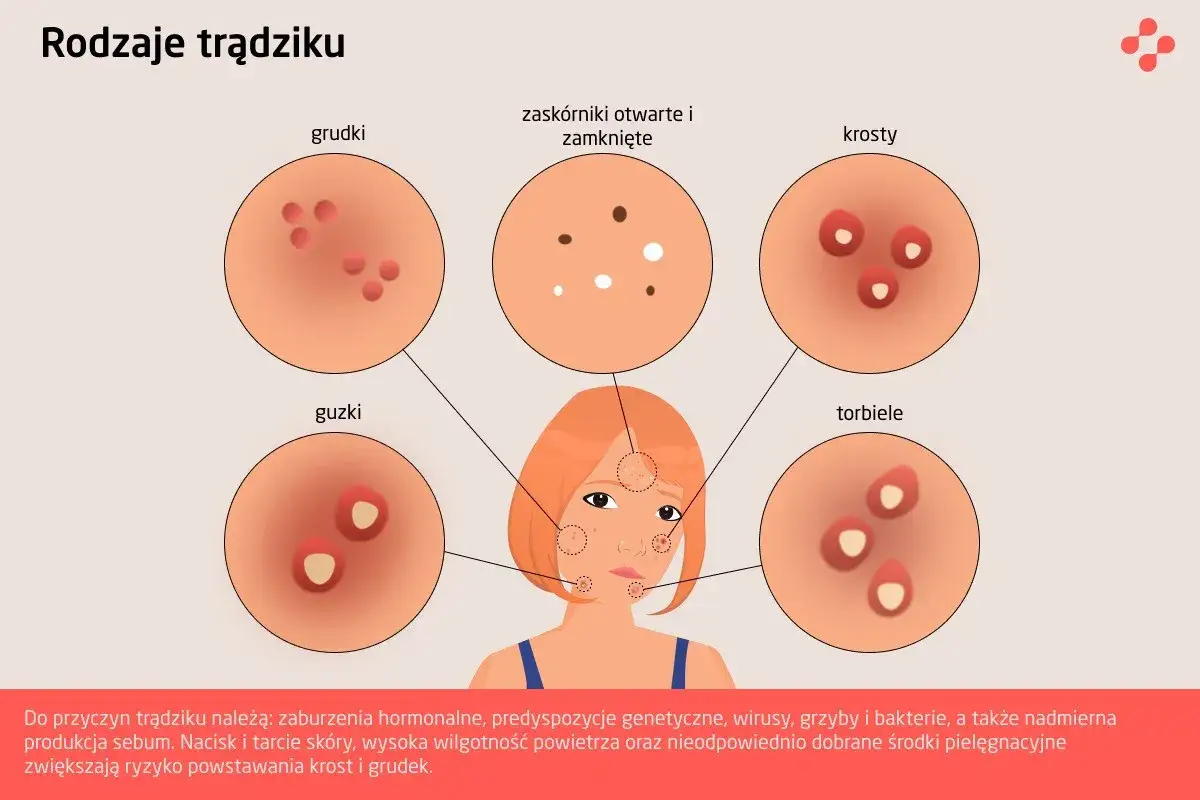 rodzaje pryszczy na twarzy grafika