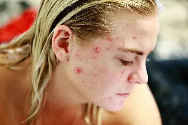 wizyta u dermatologa trądzik