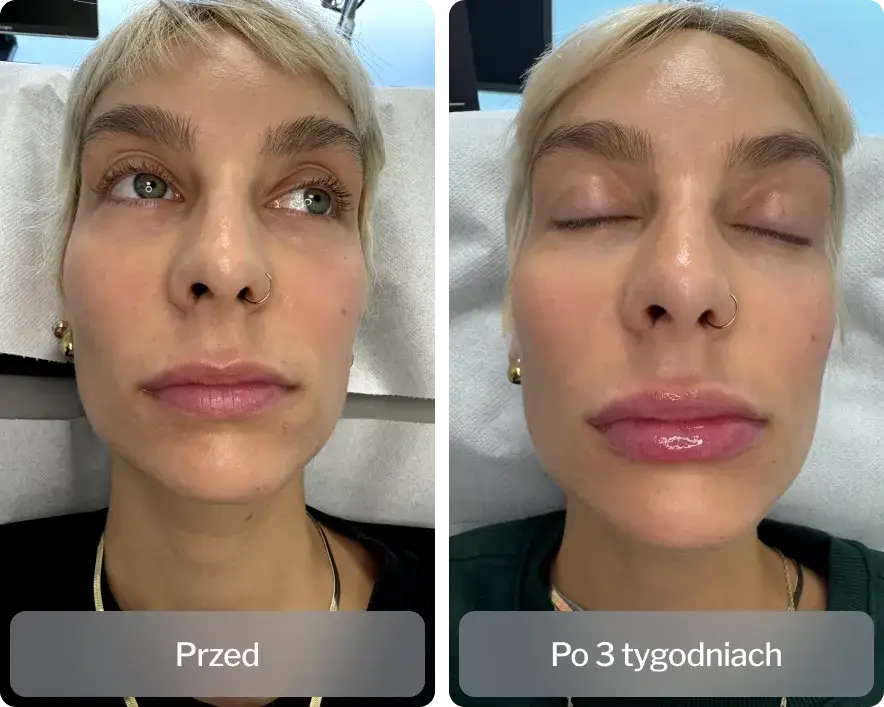 kobieta z nawilżoną skórą twarzy przed i po kwas hialuronowy