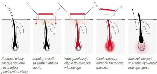 Jak działa depilacja laserowa schemat