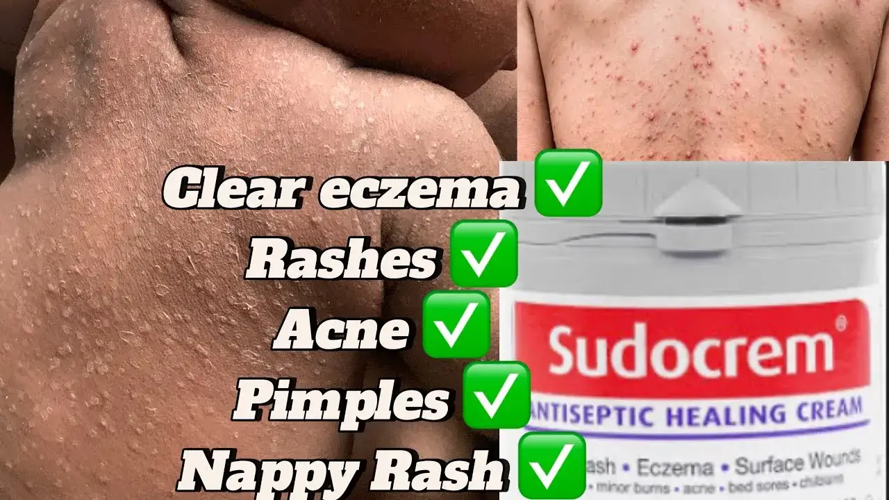Punktowa aplikacja Sudocremu na pryszcz