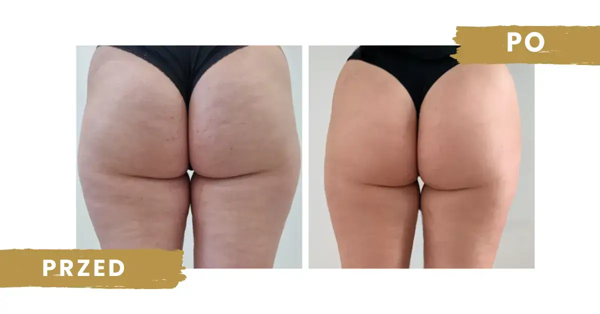 endermologia przed i po cellulit