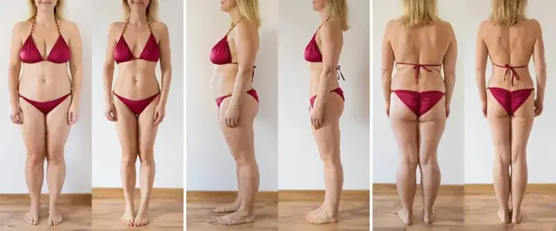 nierówności po liposukcji rodzaje